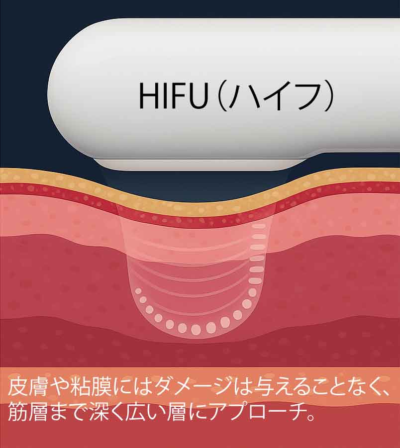 膣ハイフ・肛門ハイフ